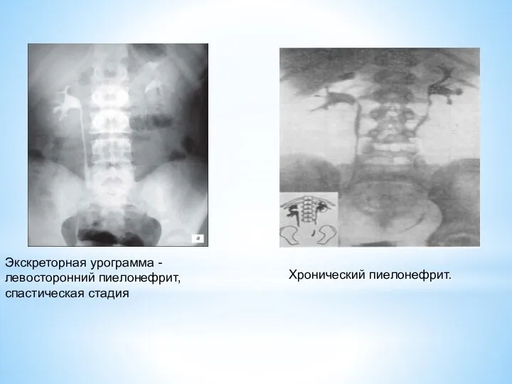 Экскреторная урограмма - левосторонний пиелонефрит, спастическая стадия Хронический пиелонефрит.