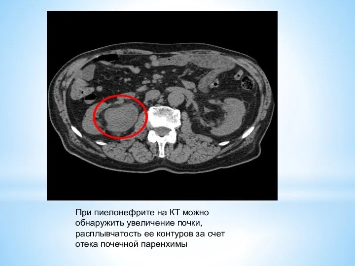 При пиелонефрите на КТ можно обнаружить увеличение почки, расплывчатость ее контуров за счет отека почечной паренхимы