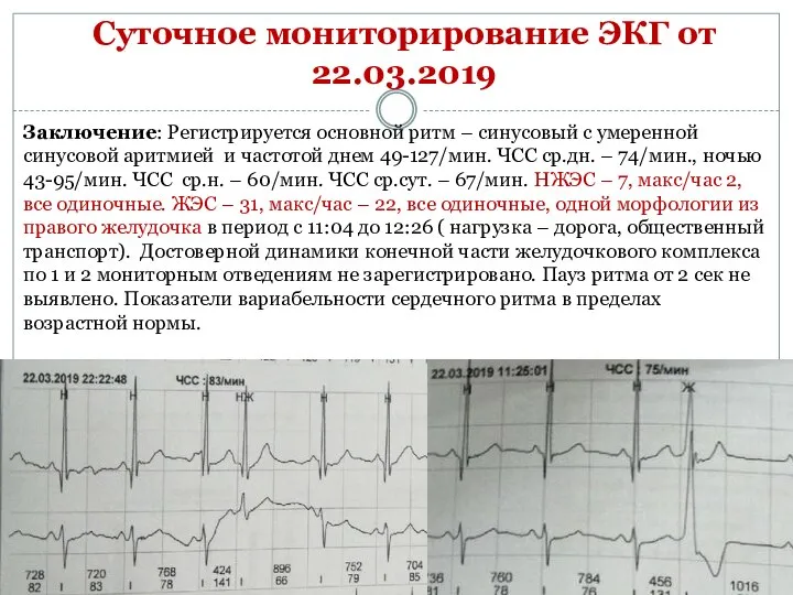 Суточное мониторирование ЭКГ от 22.03.2019 Заключение: Регистрируется основной ритм – синусовый