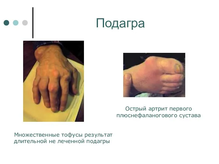Подагра Множественные тофусы результат длительной не леченной подагры Острый артрит первого плюснефаланогового сустава