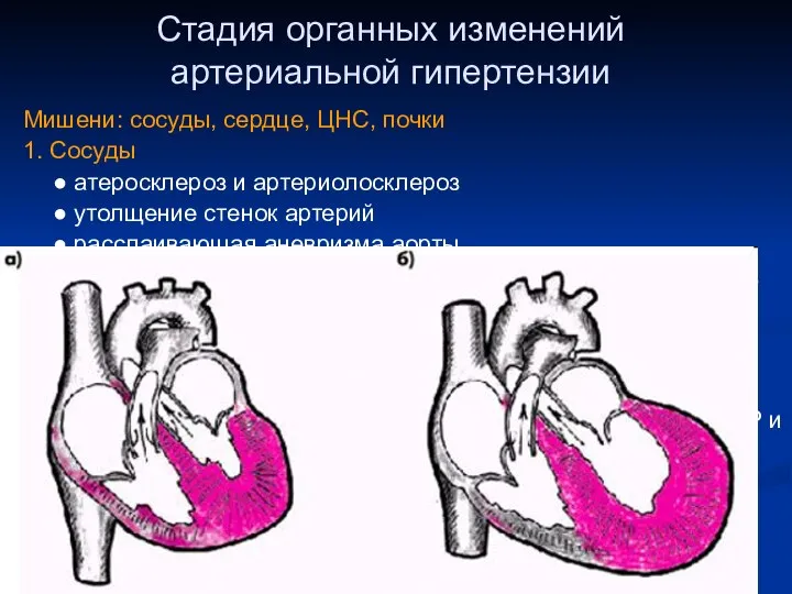 Стадия органных изменений артериальной гипертензии Мишени: сосуды, сердце, ЦНС, почки 1.