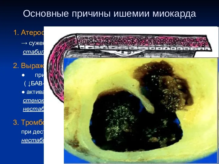 Основные причины ишемии миокарда 1. Атеросклероз (95 – 97 %) –