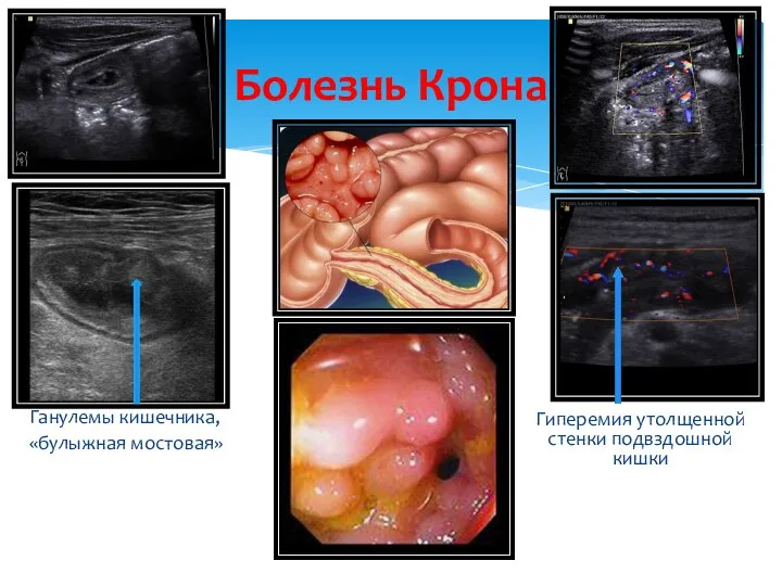 Болезнь Крона Гиперемия утолщенной стенки подвздошной кишки Ганулемы кишечника, «булыжная мостовая»