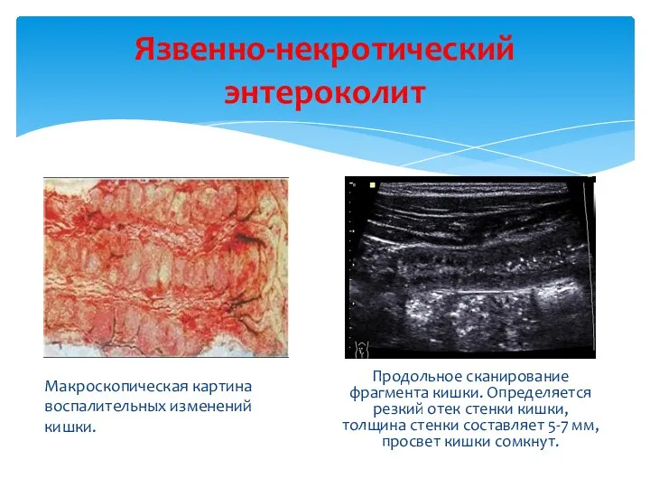 Язвенно-некротический энтероколит Макроскопическая картина воспалительных изменений кишки. Продольное сканирование фрагмента кишки.