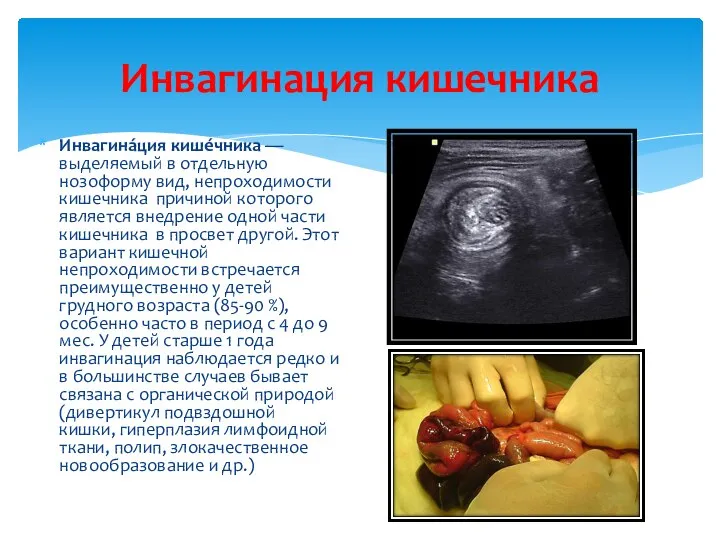 Инвагинация кишечника Инвагина́ция кише́чника — выделяемый в отдельную нозоформу вид, непроходимости