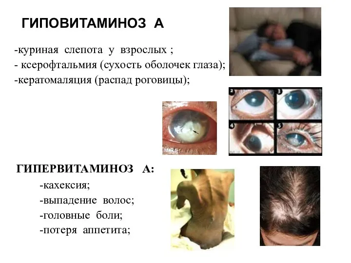 ГИПОВИТАМИНОЗ А -куриная слепота у взрослых ; - ксерофтальмия (сухость оболочек