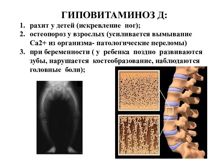 ГИПОВИТАМИНОЗ Д: рахит у детей (искревление ног); остеопороз у взрослых (усиливается