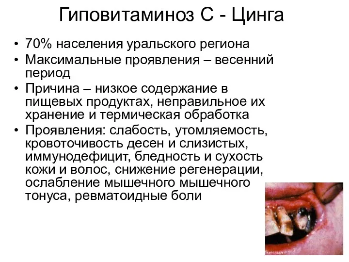 Гиповитаминоз С - Цинга 70% населения уральского региона Максимальные проявления –