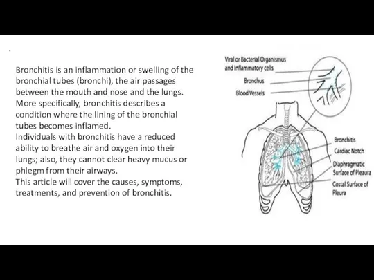 . Bronchitis is an inflammation or swelling of the bronchial tubes