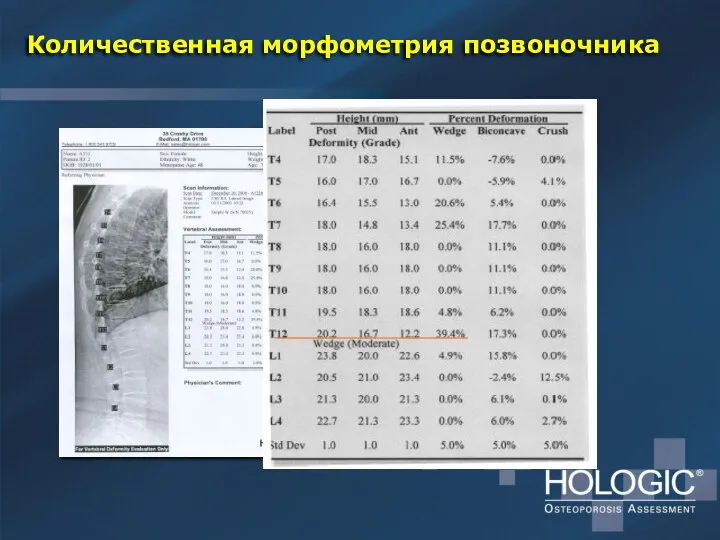 Количественная морфометрия позвоночника