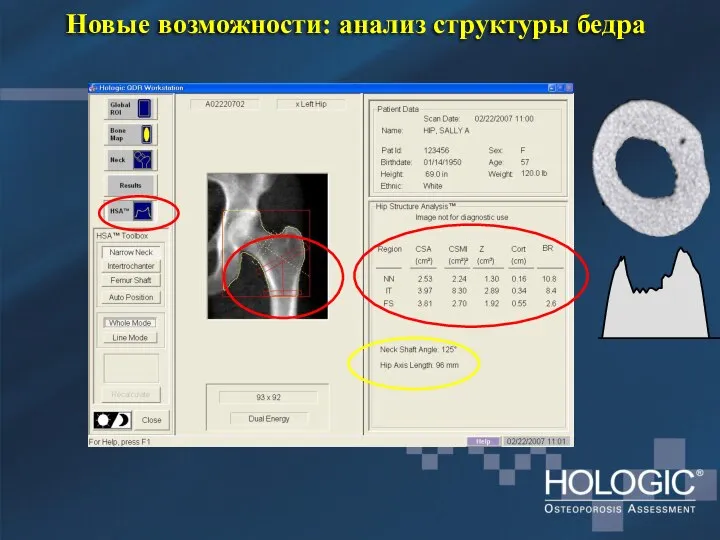 Новые возможности: анализ структуры бедра