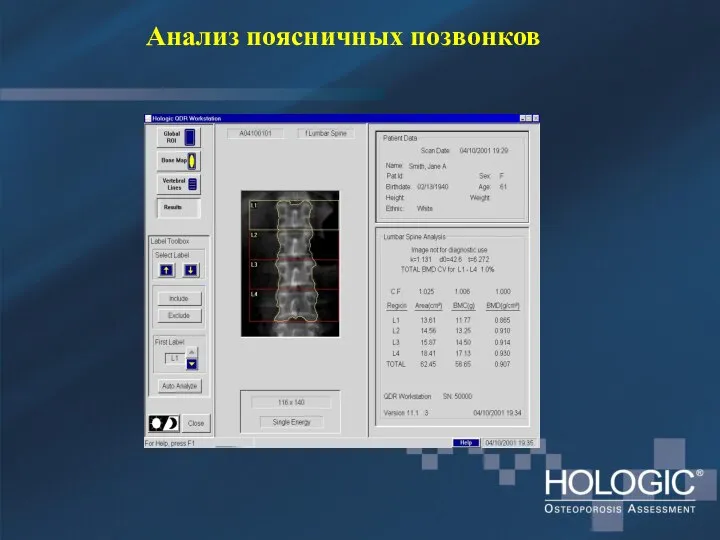 Анализ поясничных позвонков