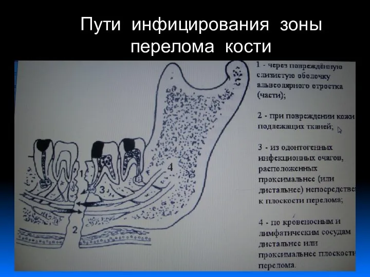 Пути инфицирования зоны перелома кости