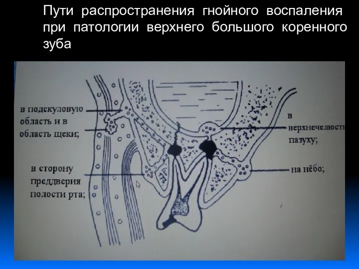 Пути распространения гнойного воспаления при патологии верхнего большого коренного зуба