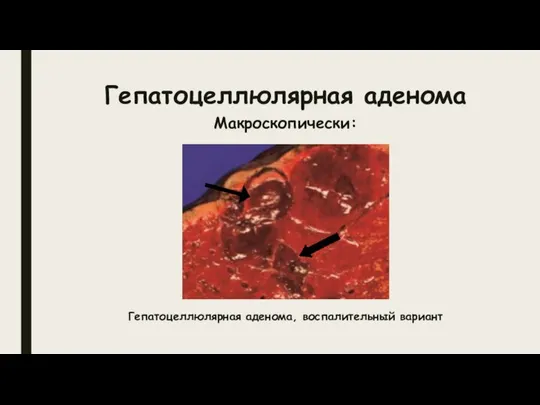 Гепатоцеллюлярная аденома Макроскопически: Гепатоцеллюлярная аденома, воспалительный вариант