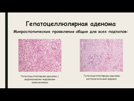 Гепатоцеллюлярная аденома Микроспопические проявления общие для всех подтипов: Гепатоцеллюлярная аденома с