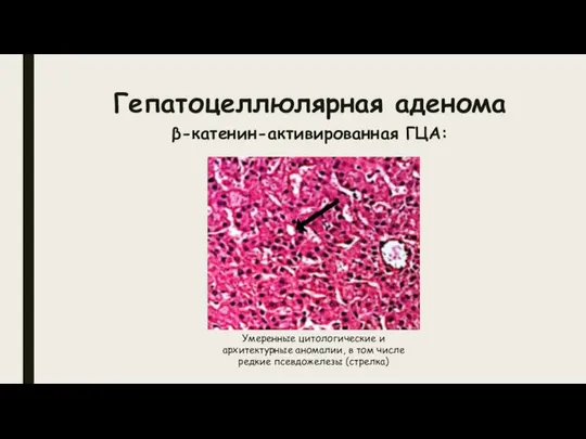 Гепатоцеллюлярная аденома β-катенин-активированная ГЦА: Умеренные цитологические и архитектурные аномалии, в том числе редкие псевдожелезы (стрелка)