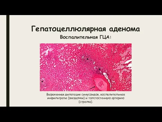 Гепатоцеллюлярная аденома Воспалительная ГЦА: Выраженная дилатация синусоидов, воспалительные инфильтраты (звездочки) и толстостенную артерию (стрелка).