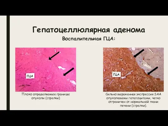 Гепатоцеллюлярная аденома Воспалительная ГЦА: Плохо определяемые границы опухоли (стрелки) ГЦА ГЦА