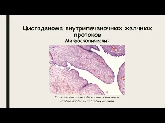 Цистаденома внутрипеченочных желчных протоков Микроскопически: Опухоль выстлана кубическим эпителием. Строма напоминает строму яичника