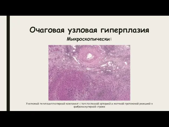 Очаговая узловая гиперплазия Микроскопически: Узелковый гепатоцеллюлярный компонент с толстостенной артерией и
