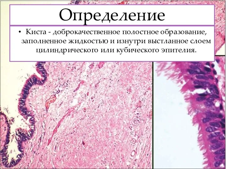 Определение Киста - доброкачественное полостное образование, заполненное жидкостью и изнутри выстланное слоем цилиндрического или кубического эпителия.