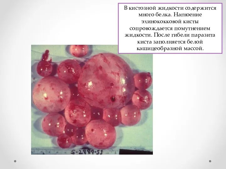 В кистозной жидкости содержится много белка. Нагноение эхинококковой кисты сопровождается помутнением