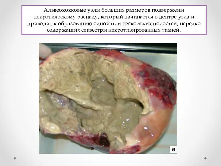 Альвеококковые узлы больших размеров подвержены некротическому распаду, который начинается в центре