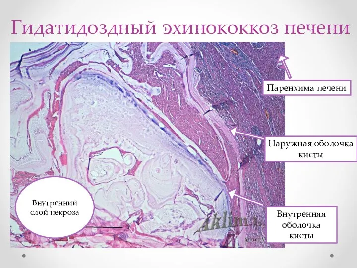 Гидатидоздный эхинококкоз печени Паренхима печени Наружная оболочка кисты Внутренняя оболочка кисты Внутренний слой некроза