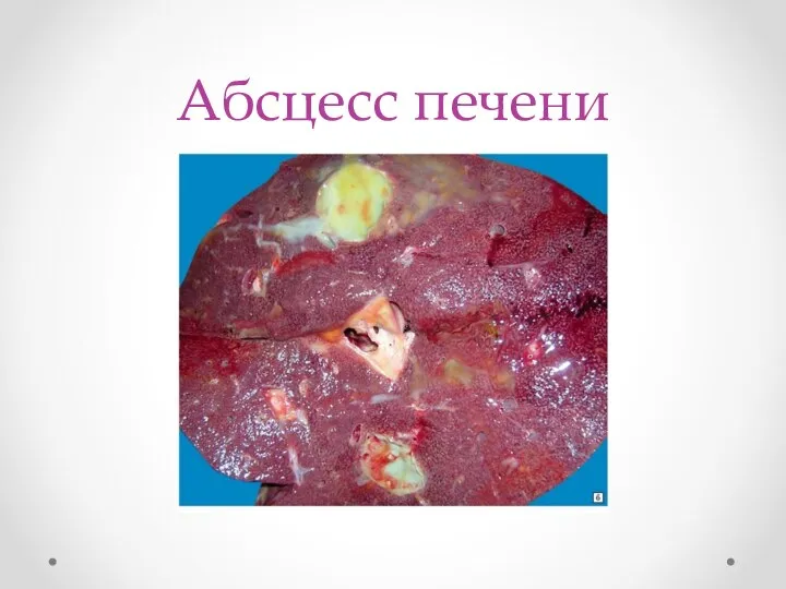 Абсцесс печени