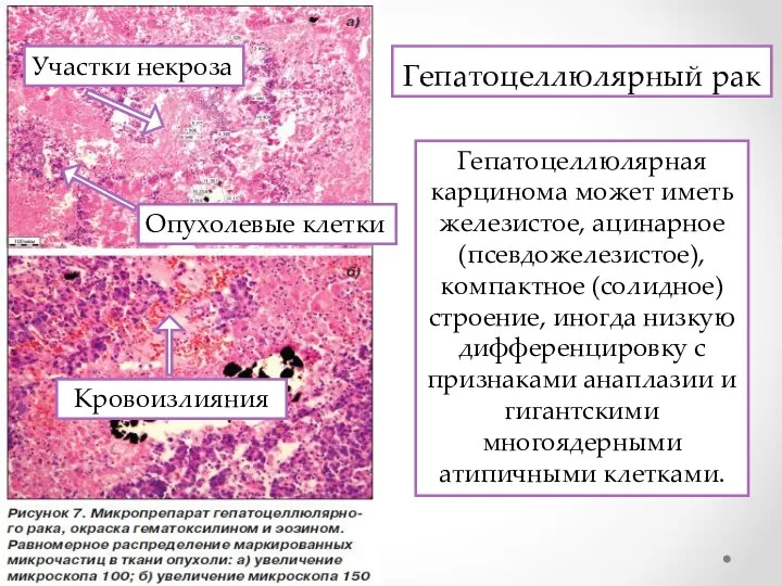 Гепатоцеллюлярный рак Гепатоцеллюлярная карцинома может иметь железистое, ацинарное (псевдожелезистое), компактное (солидное)