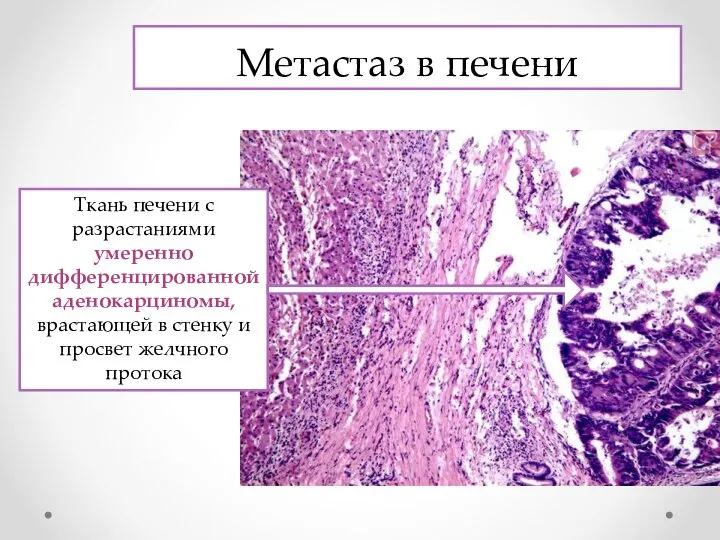 Метастаз в печени Ткань печени с разрастаниями умеренно дифференцированной аденокарциномы, врастающей