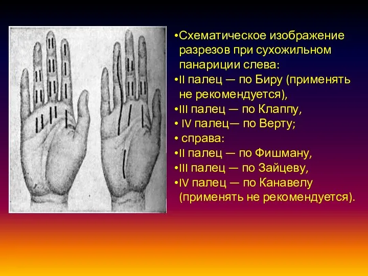 Схематическое изображение разрезов при сухожильном панариции слева: II палец — по