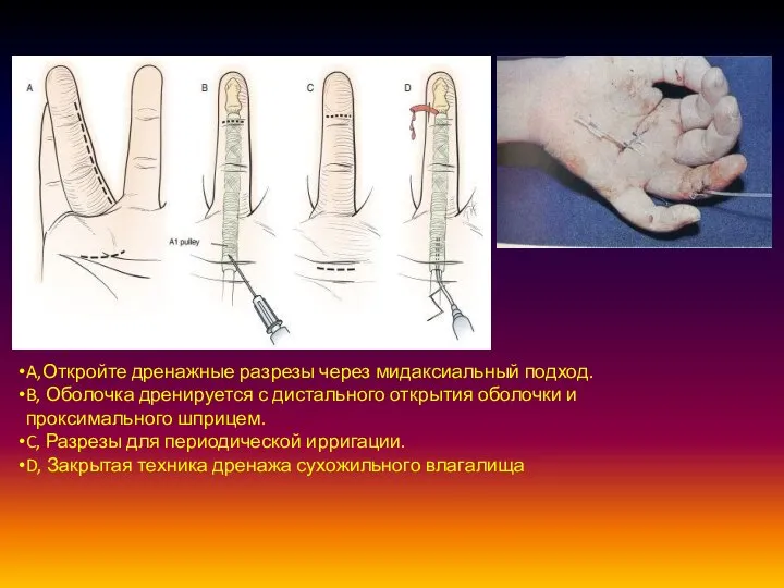 A,Откройте дренажные разрезы через мидаксиальный подход. B, Оболочка дренируется с дистального