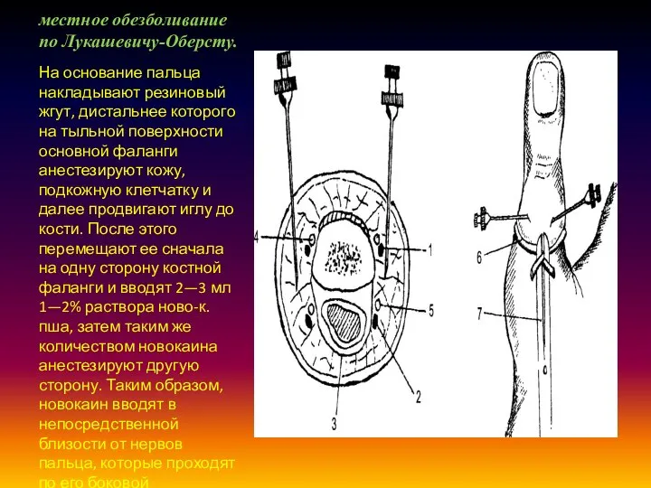 местное обезболивание по Лукашевичу-Оберсту. На основание пальца накладывают резиновый жгут, дистальнее