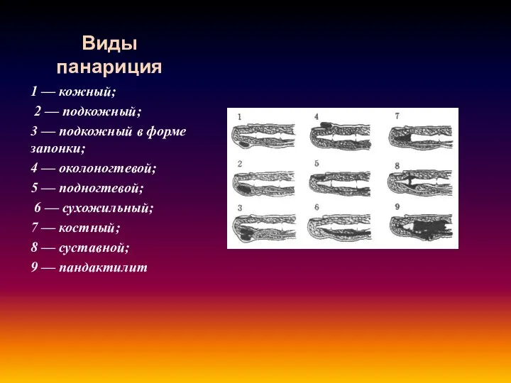 Виды панариция 1 — кожный; 2 — подкожный; 3 — подкожный