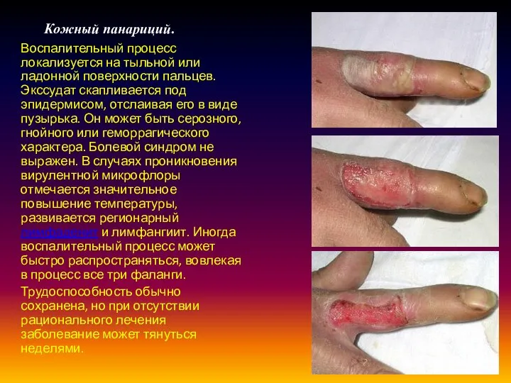 Кожный панариций. Воспалительный процесс локализуется на тыльной или ладонной поверхности пальцев.