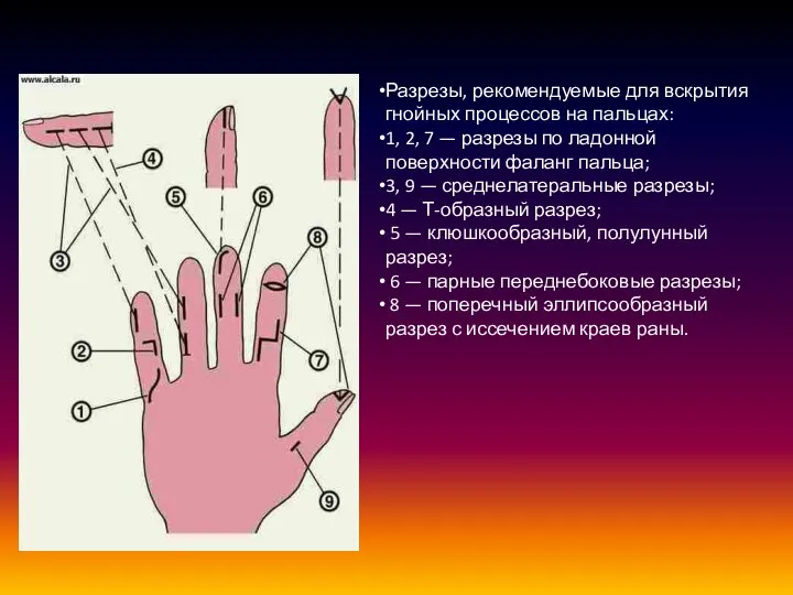 Разрезы, рекомендуемые для вскрытия гнойных процессов на пальцах: 1, 2, 7