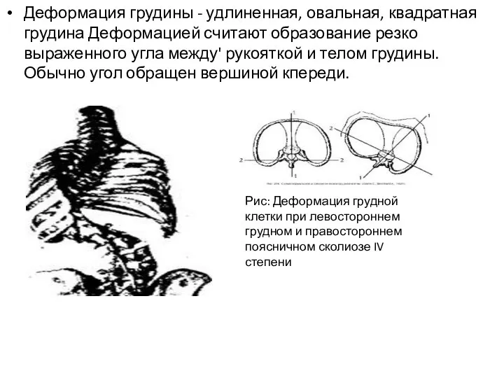 Деформация грудины - удлиненная, овальная, квадратная грудина Деформацией считают образование резко