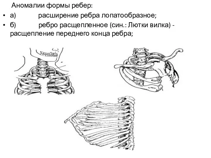 Аномалии формы ребер: а) расширение ребра лопатообразное; б) ребро расщепленное (син.: