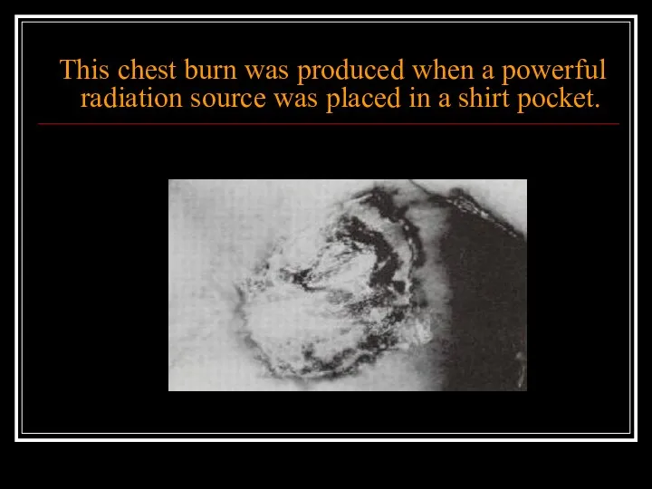 This chest burn was produced when a powerful radiation source was placed in a shirt pocket.