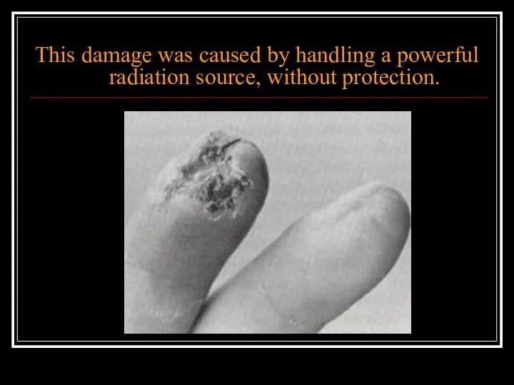 This damage was caused by handling a powerful radiation source, without protection.