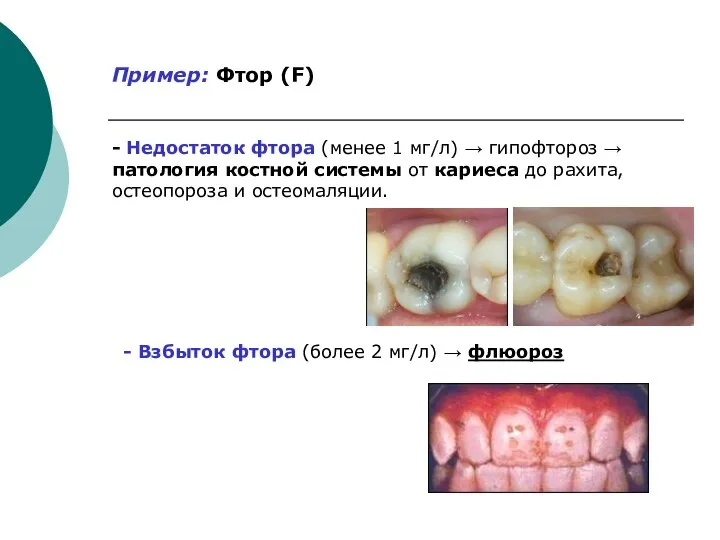 Пример: Фтор (F) - Недостаток фтора (менее 1 мг/л) → гипофтороз