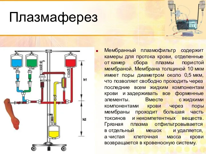 Плазмаферез Мембранный плазмофильтр содержит камеры для протока крови, отделенные от камер