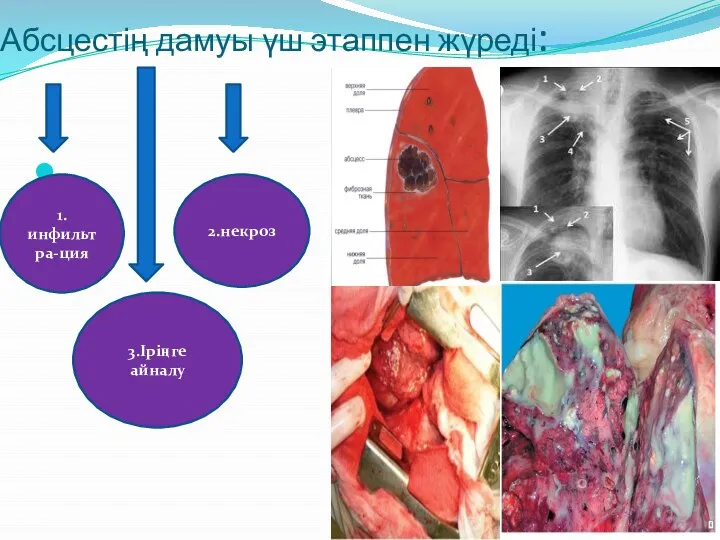 Абсцестің дамуы үш этаппен жүреді: 1.инфильтра-ция 2.некроз 3.Іріңге айналу