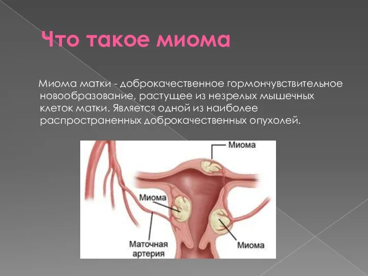 Что такое миома Миома матки - доброкачественное гормончувствительное новообразование, растущее из