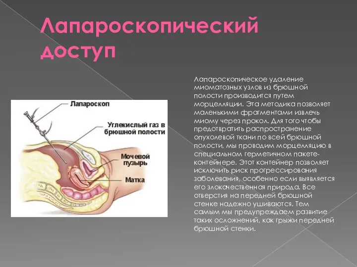 Лапароскопический доступ Лапароскопическое удаление миоматозных узлов из брюшной полости производится путем