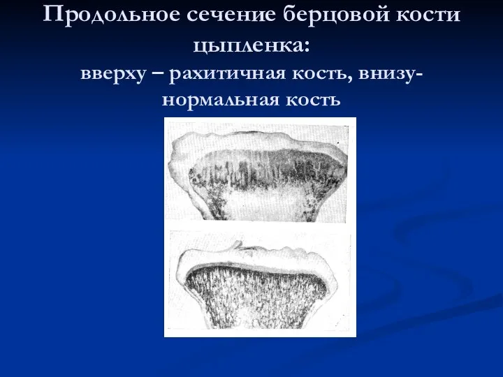 Продольное сечение берцовой кости цыпленка: вверху – рахитичная кость, внизу- нормальная кость