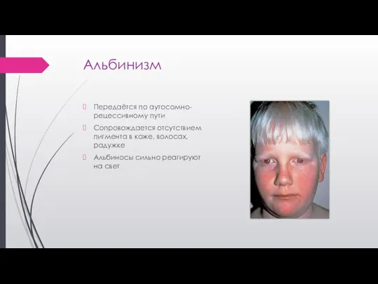 Альбинизм Передаётся по аутосомно-рецессивному пути Сопровождается отсутствием пигмента в коже, волосах,