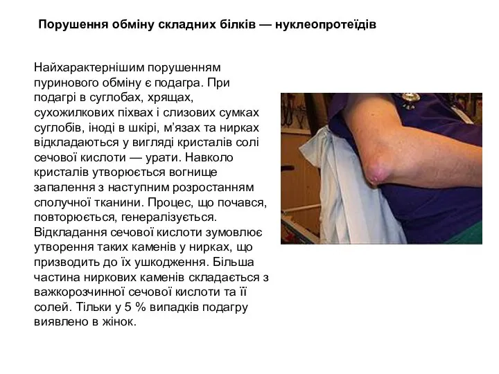 Найхарактернішим порушенням пуринового обміну є подагра. При подагрі в суглобах, хрящах,